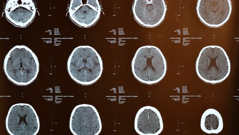 Read more about the article Revolutionizing Stroke Care: The Impact of Artificial Intelligence at Worcestershire Royal Hospital